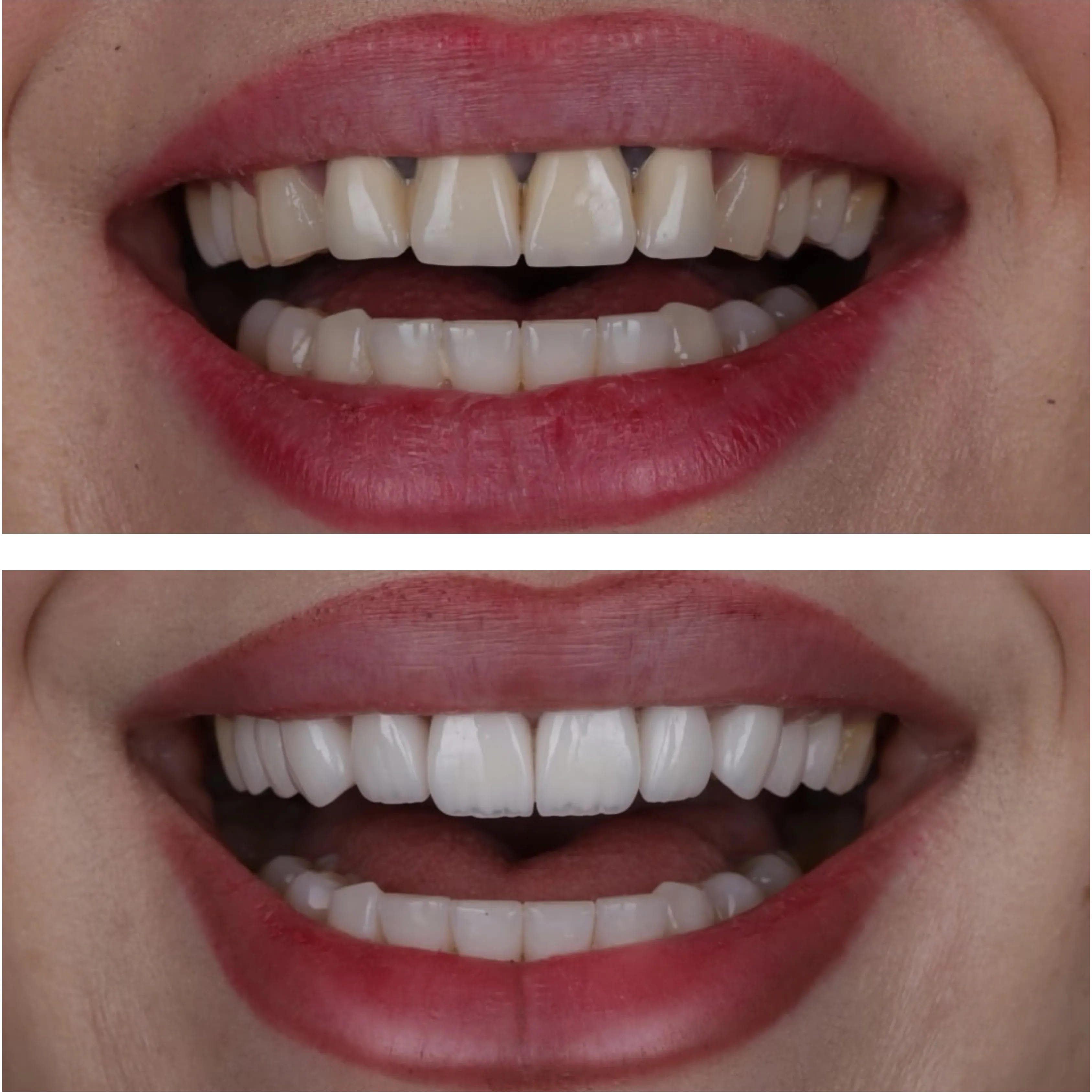 Before and after porcelain veneer smile makeover